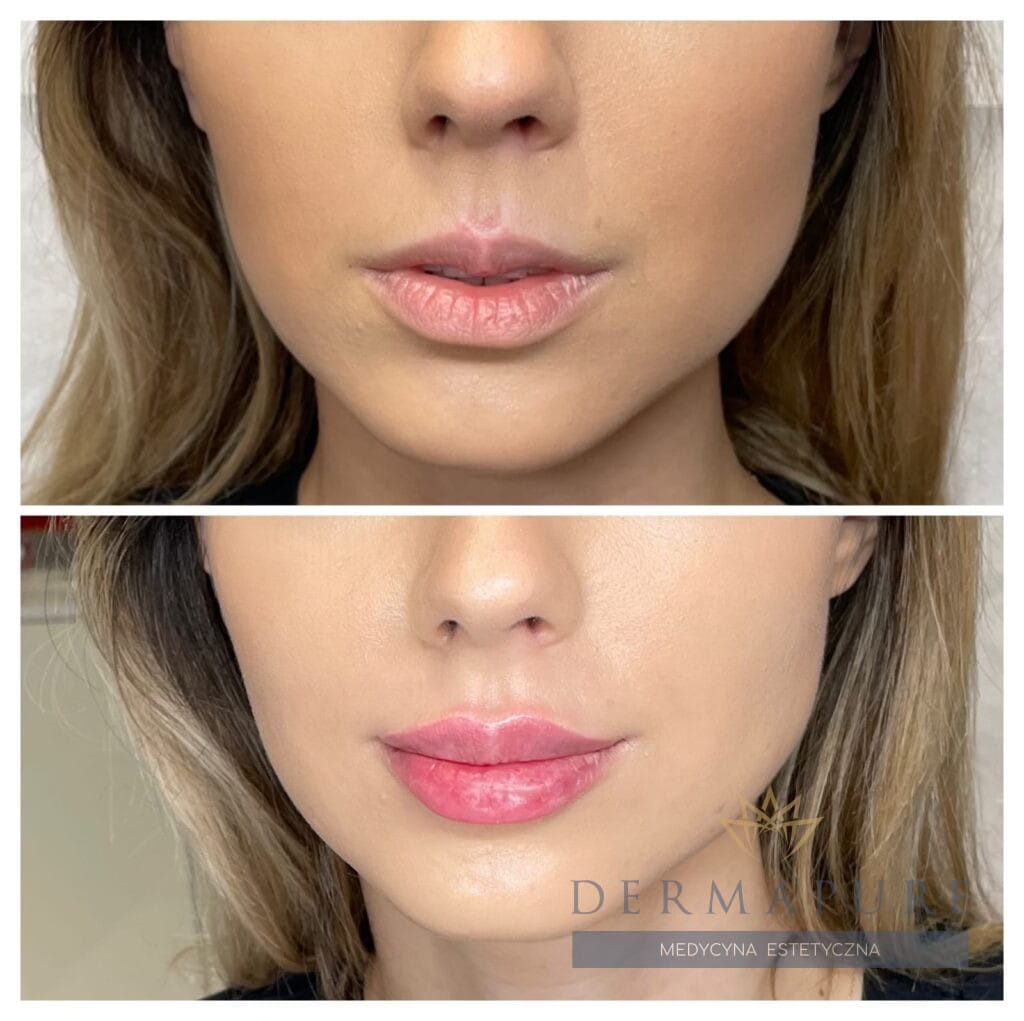 Powiększone i wymodelowane usta po zabiegu w Warszawie.