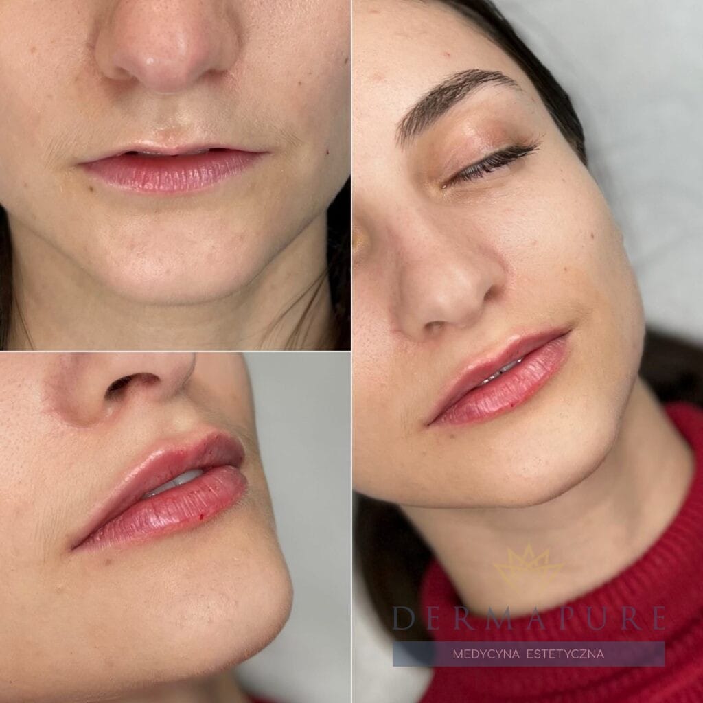 Efekt pełniejszych ust po zastosowaniu kwasu hialuronowego, Warszawa.