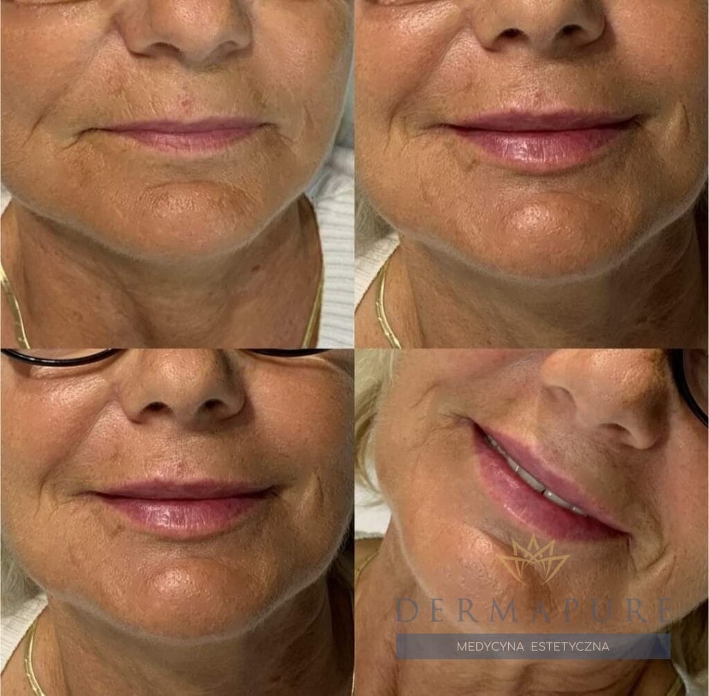 Usta po zabiegu kwasem hialuronowym w Warszawie – widoczne efekty.