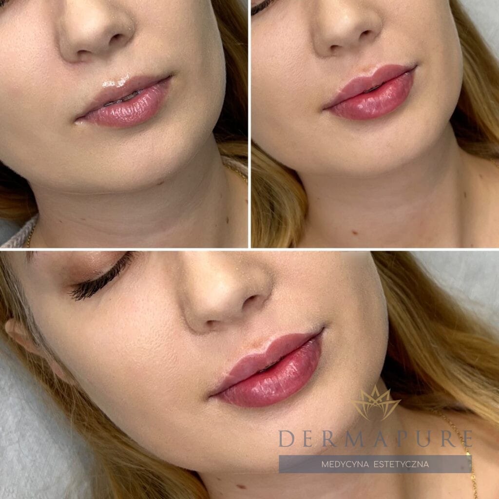 Delikatne powiększanie ust w Warszawie, Dermapure.