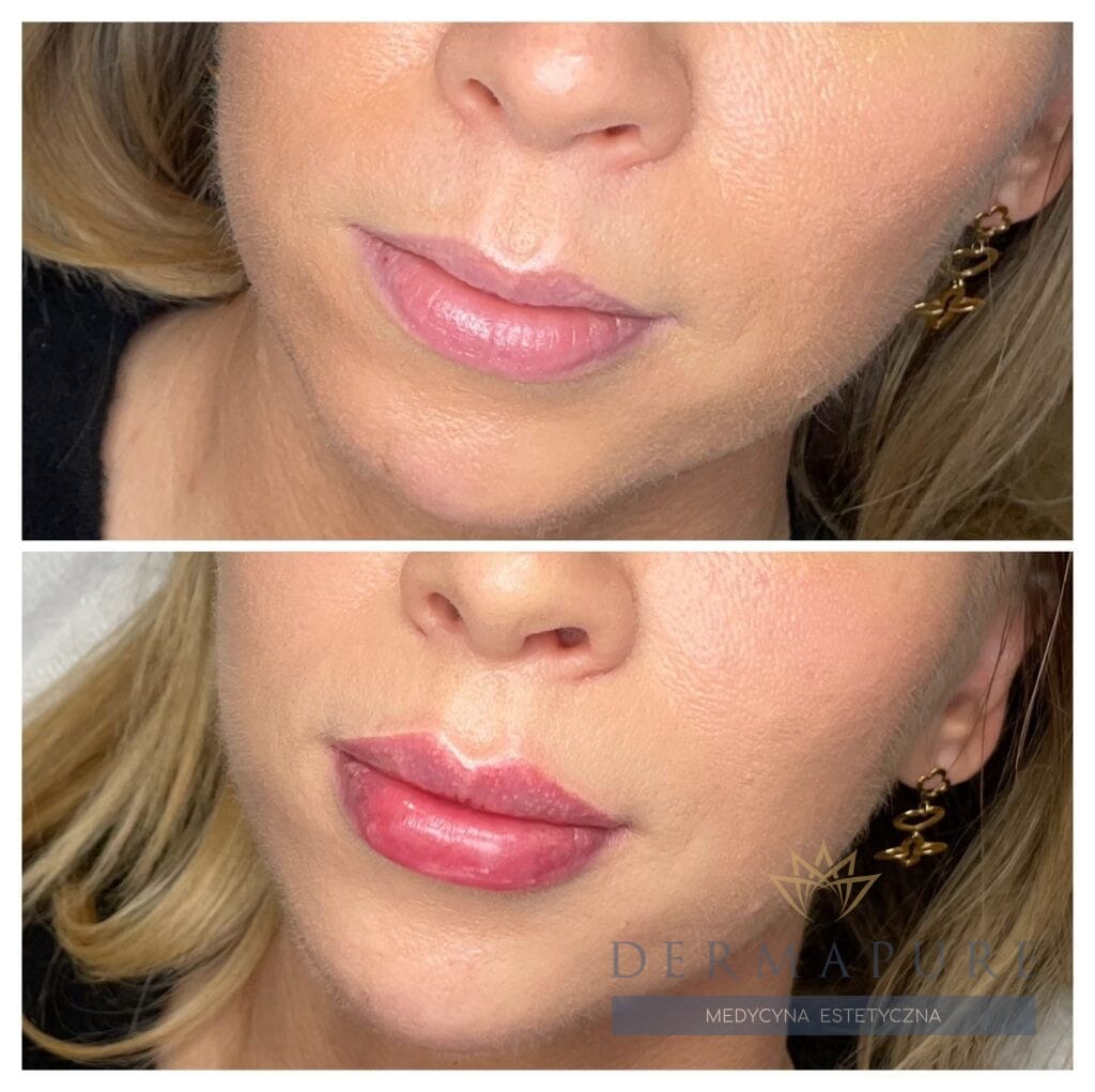 Subtelne powiększenie ust kwasem hialuronowym w Warszawie – efekt zabiegu.