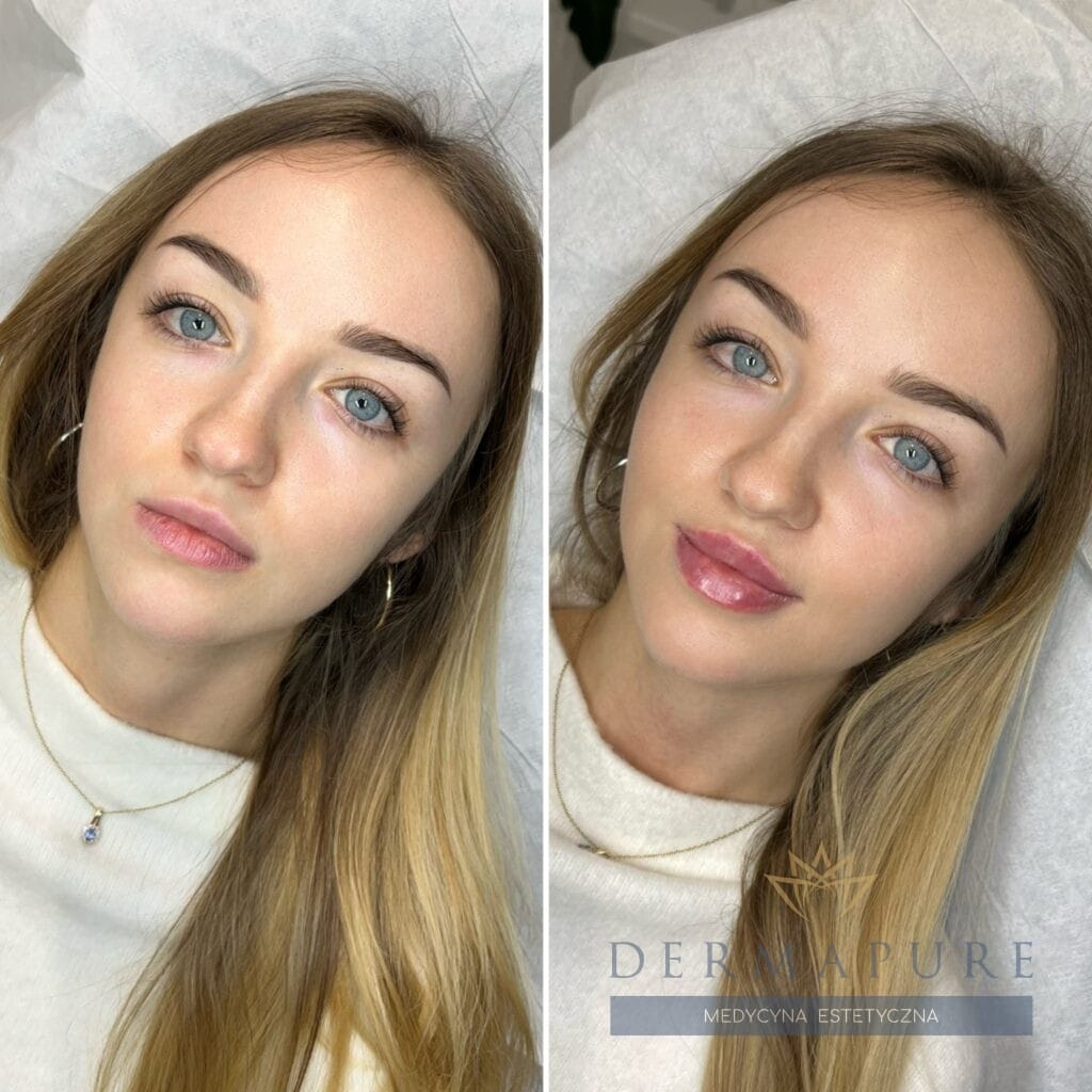 Warszawa – rezultaty modelowania ust kwasem hialuronowym.