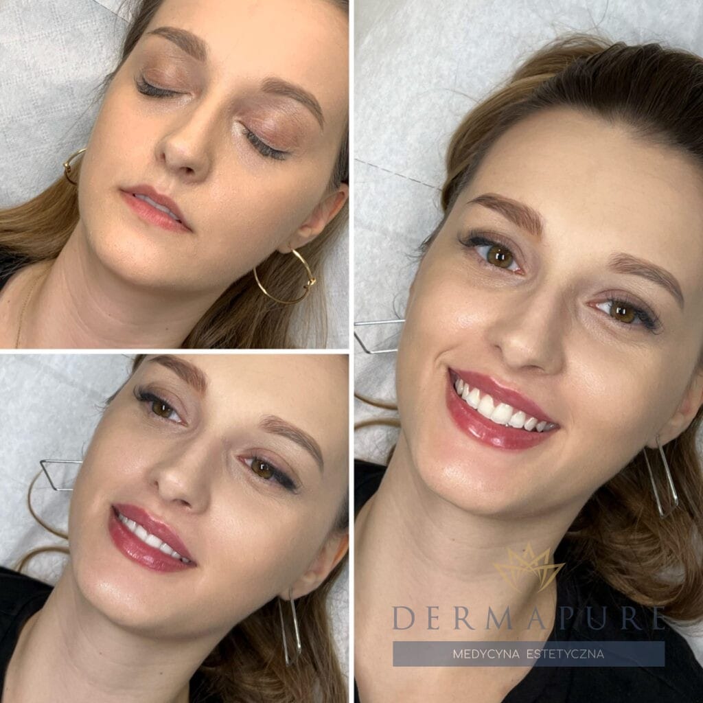 Efekt końcowy modelowania ust kwasem hialuronowym w Warszawie.