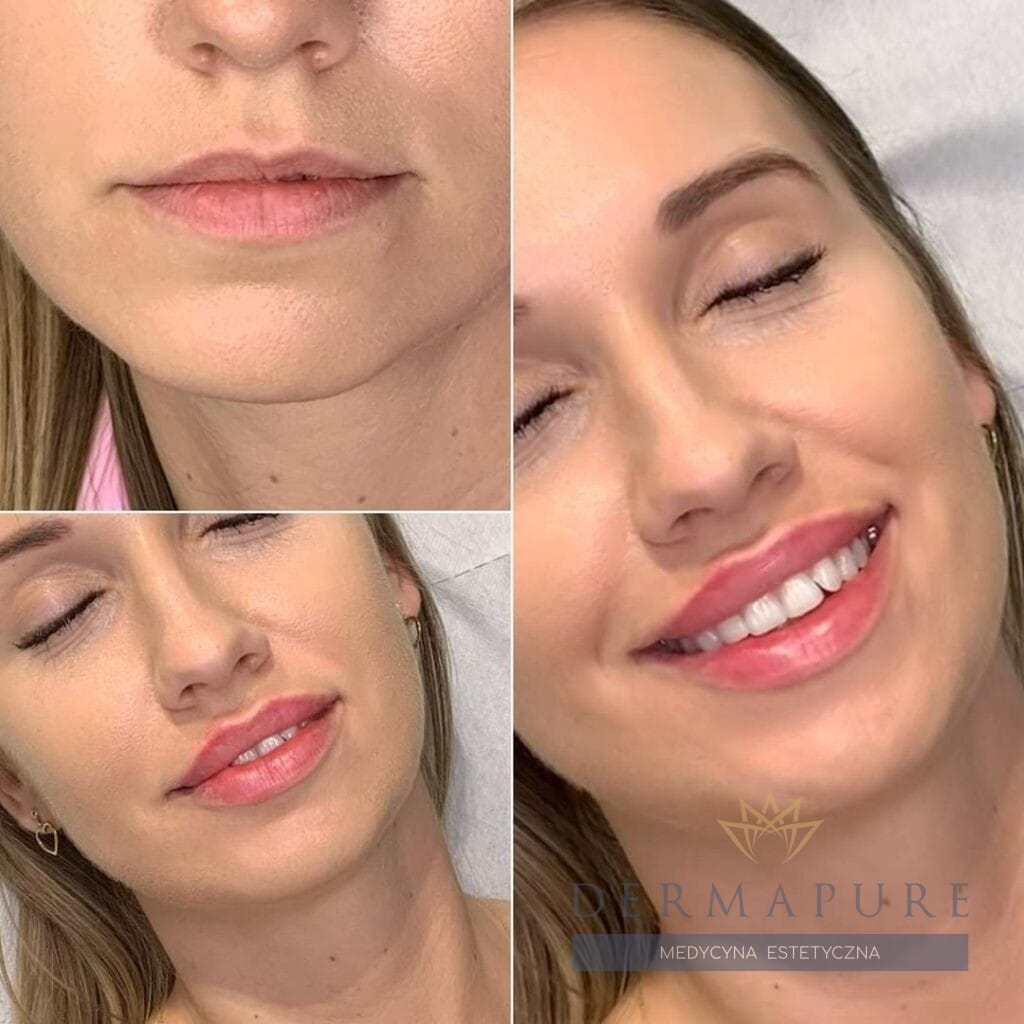 Efekty modelowania ust kwasem hialuronowym – Dermapure Warszawa.