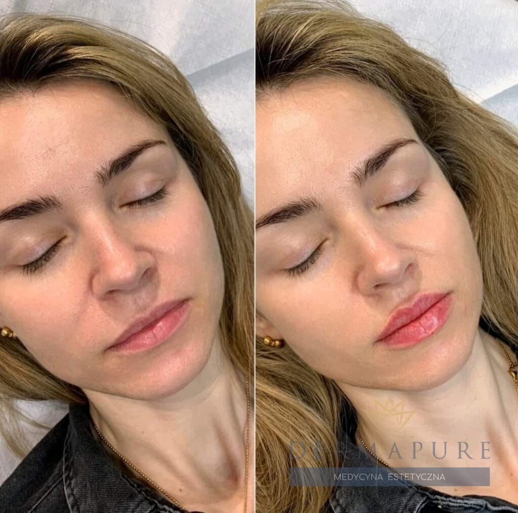 Profesjonalne powiększanie ust w Dermapure, Warszawa.
