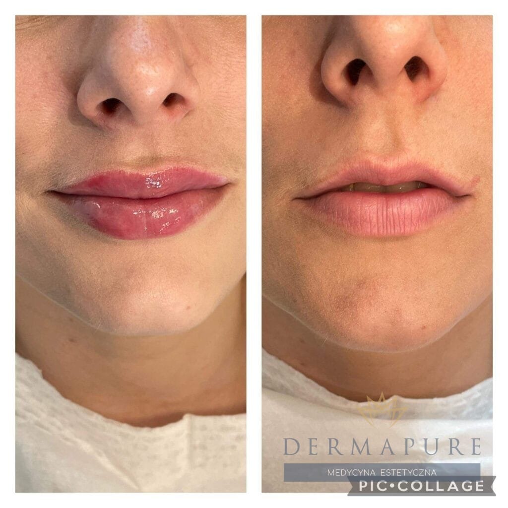Zabieg powiększania ust kwasem hialuronowym w Warszawie – efekt pełnych, naturalnych ust.