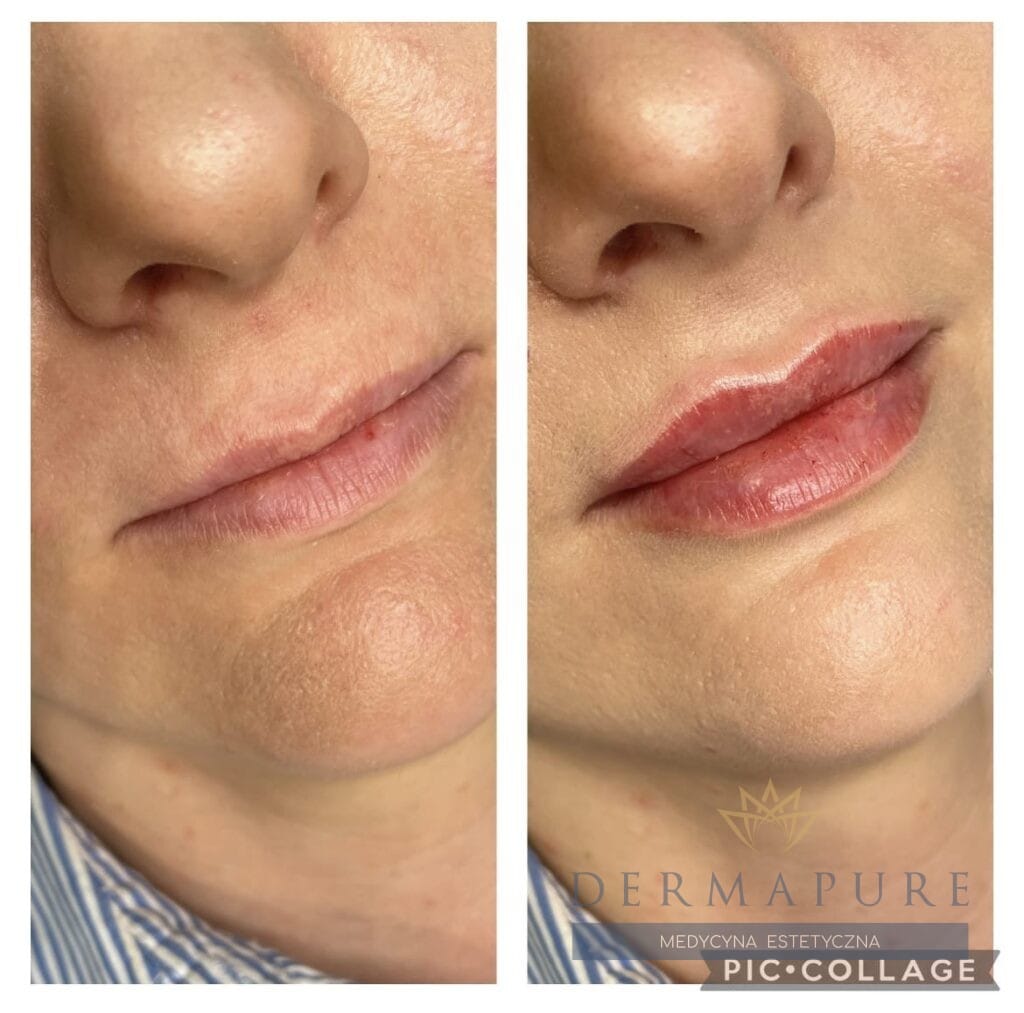 Powiększanie ust kwasem hialuronowym w Warszawie – wyraźne efekty.
