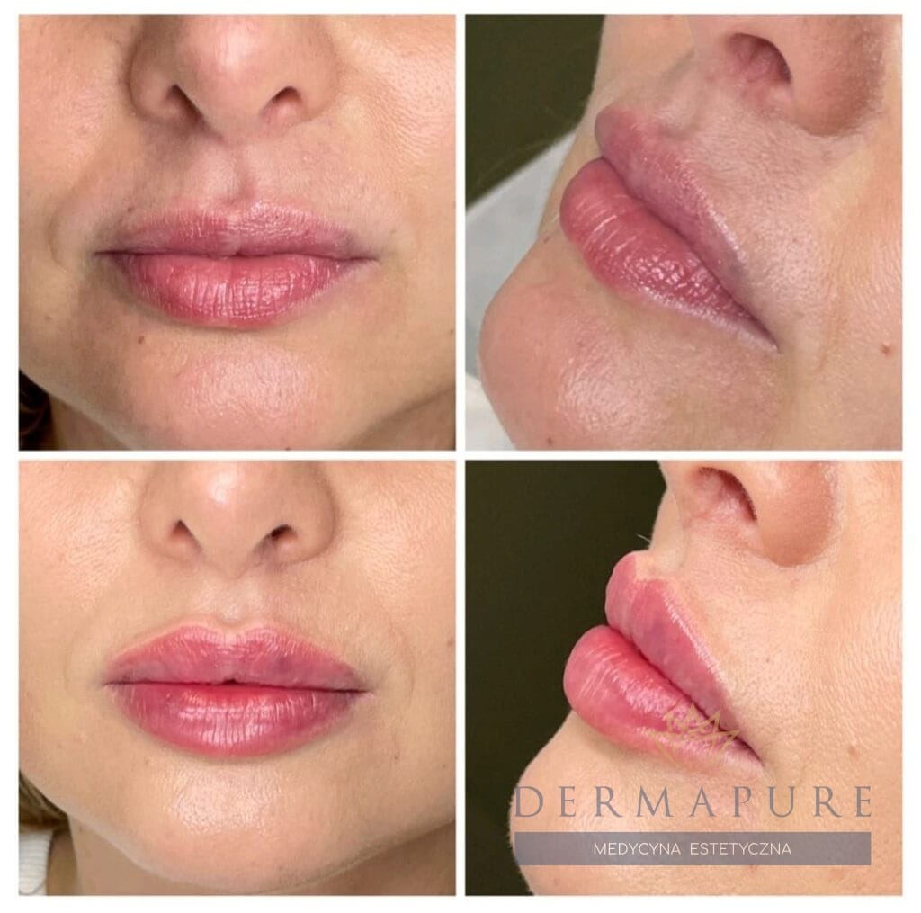 Przed i po zabiegu modelowania ust kwasem hialuronowym – widoczna poprawa konturów.