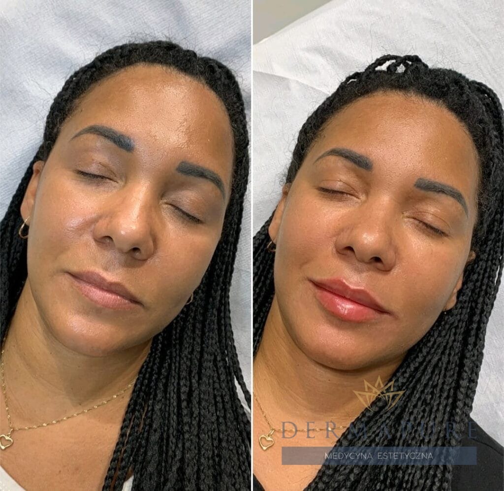 Zabieg modelowania ust w klinice Dermapure w Warszawie.