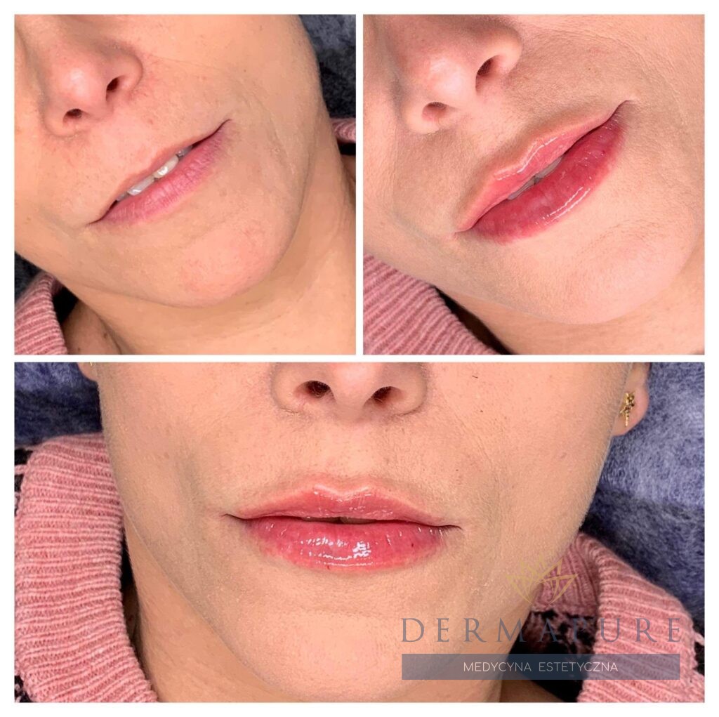Efekt przed i po zabiegu powiększania ust – Dermapure Warszawa.