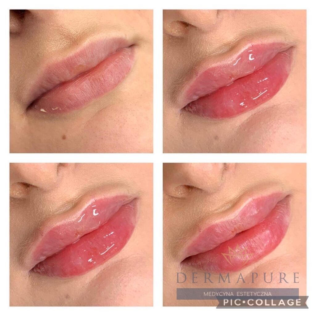 Usta po zabiegu kwasem hialuronowym – efekt gładkiej i nawilżonej skóry w Warszawie.
