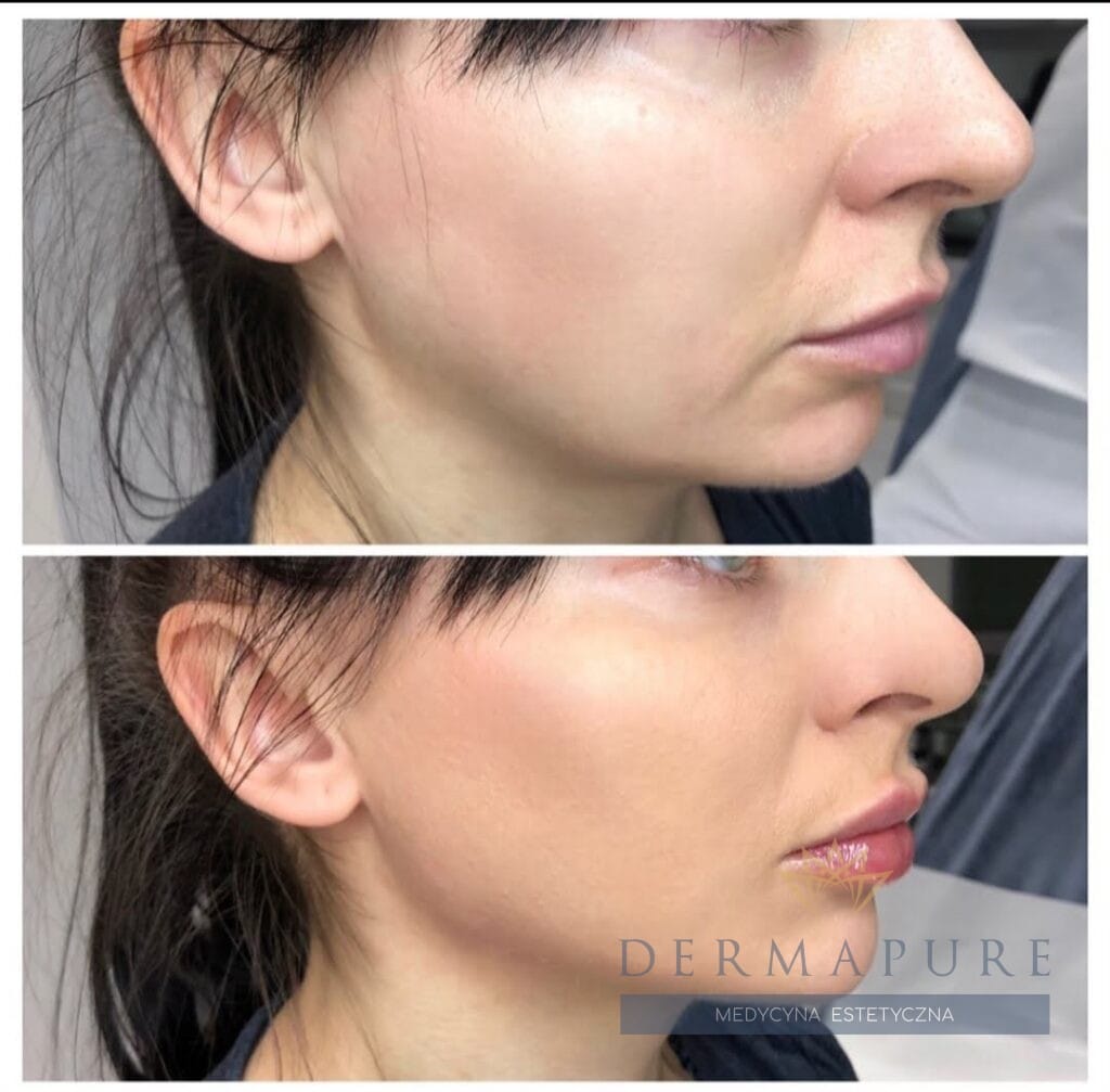 Profesjonalny full face lifting w Dermapure, Warszawa