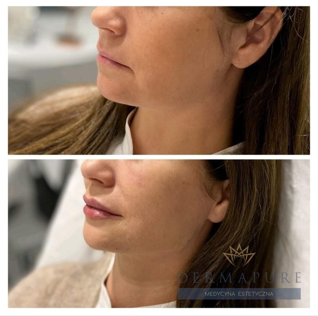Efekty full face lifting w Dermapure, Warszawa