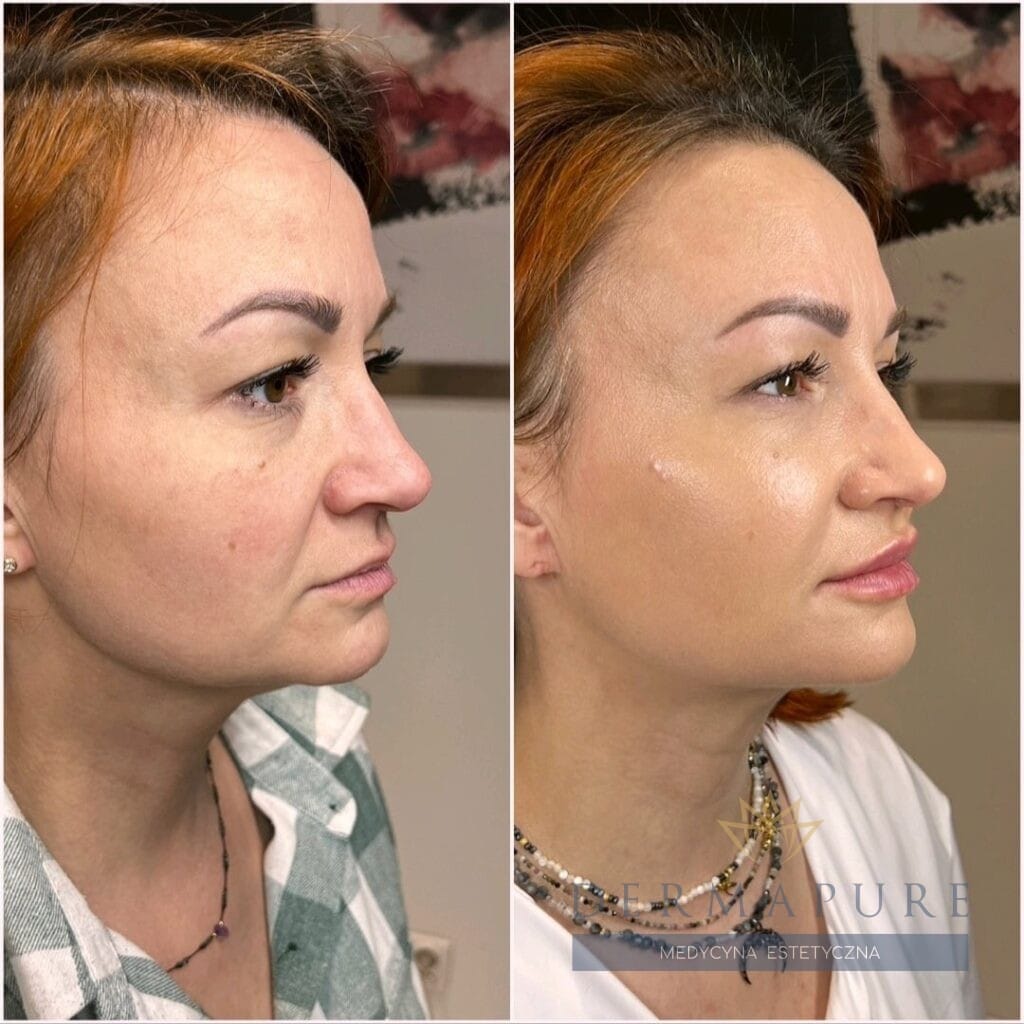 Full face lifting w Dermapure, Warszawa - przed i po