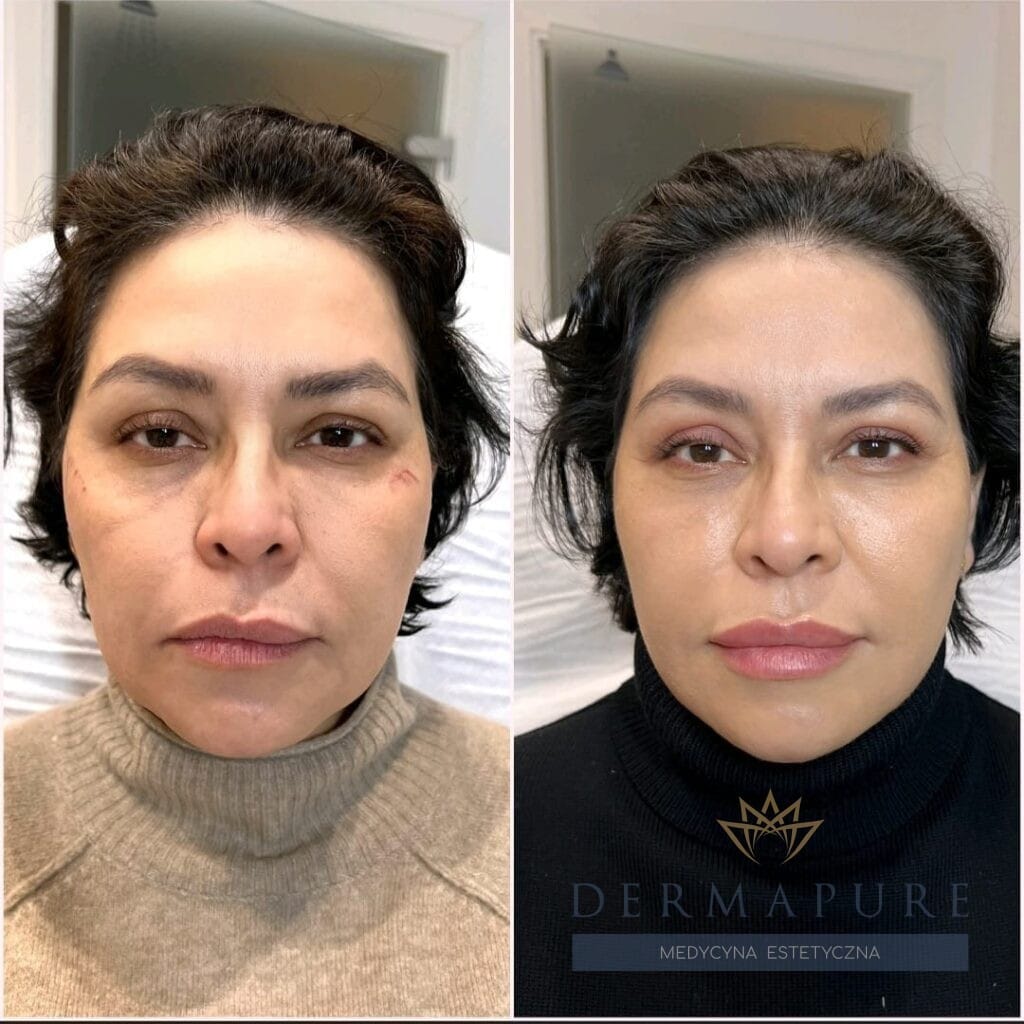 Warszawa, Dermapure - nowoczesny full face lifting