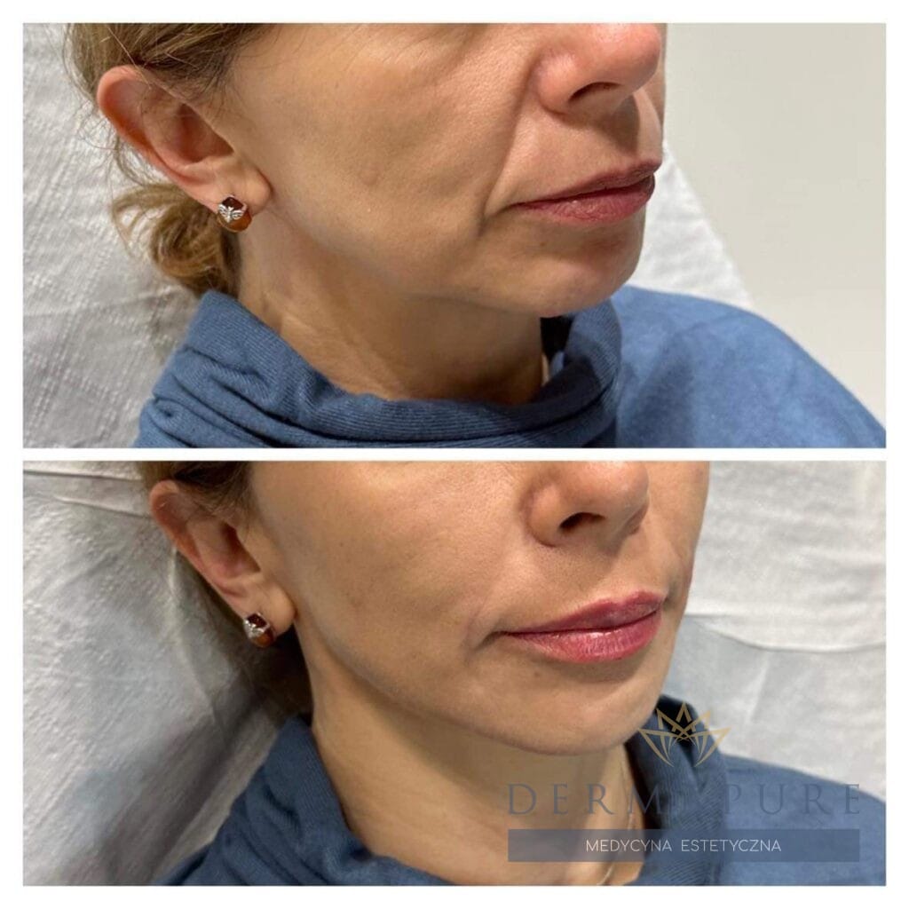 Dermapure, Warszawa - full face lifting przed i po