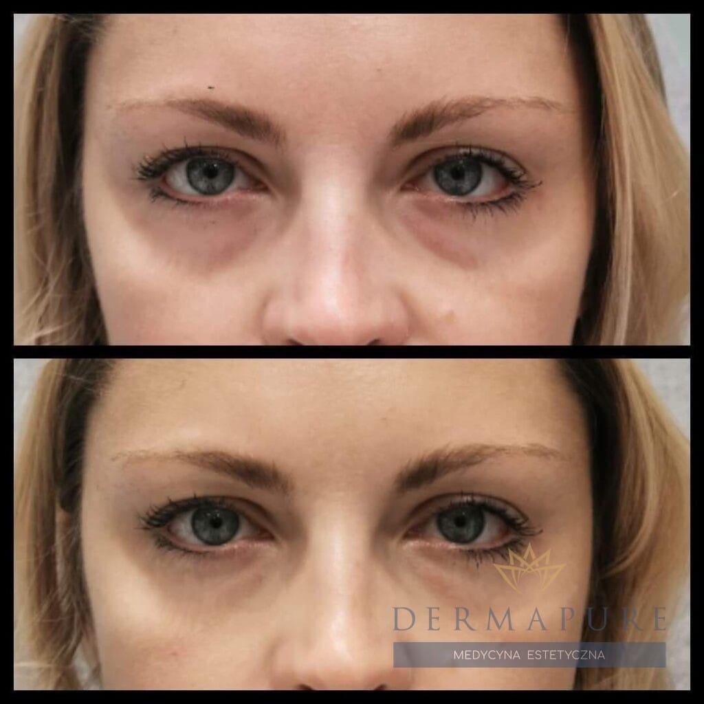 Specjalistyczne wypełnienie doliny łez w Dermapure Warszawa.