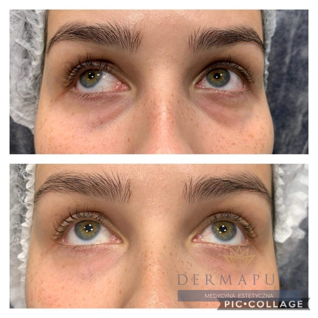 Rezultaty po wypełnieniu doliny łez w Dermapure Warszawa.