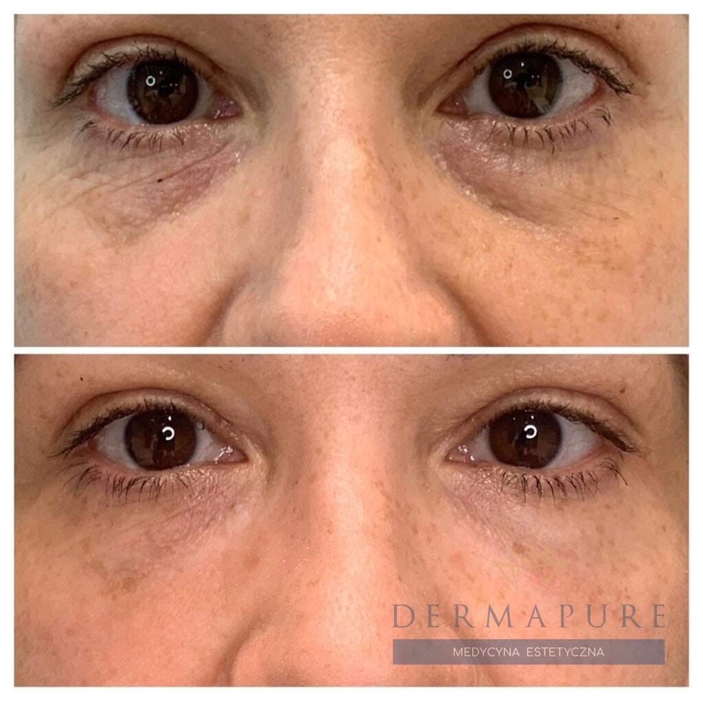 Zabieg poprawy doliny łez w Dermapure, Warszawa.