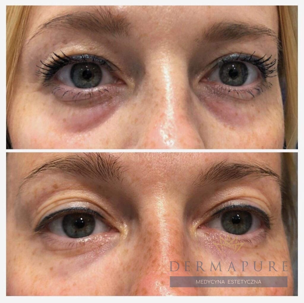 Zabieg usuwania doliny łez w klinice Dermapure w Warszawie.