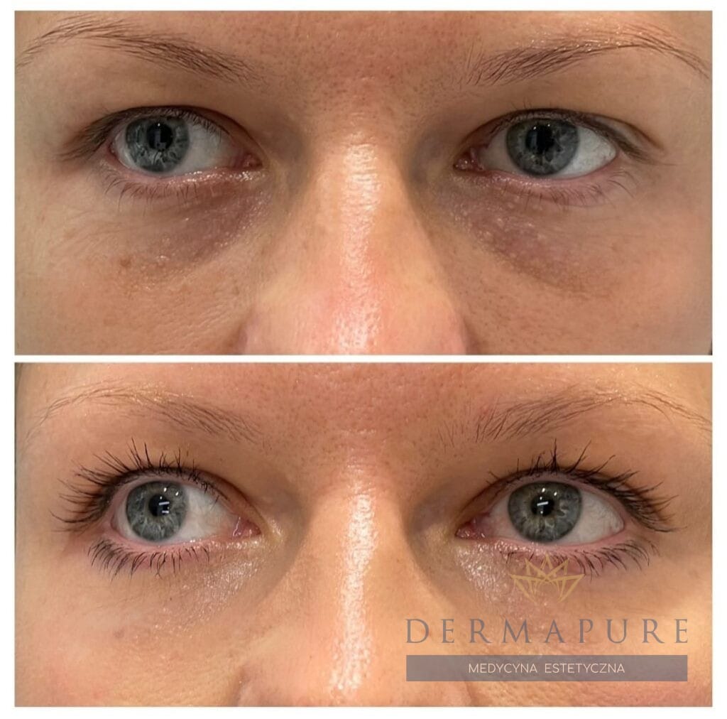 Dermapure Warszawa - modelowanie doliny łez.