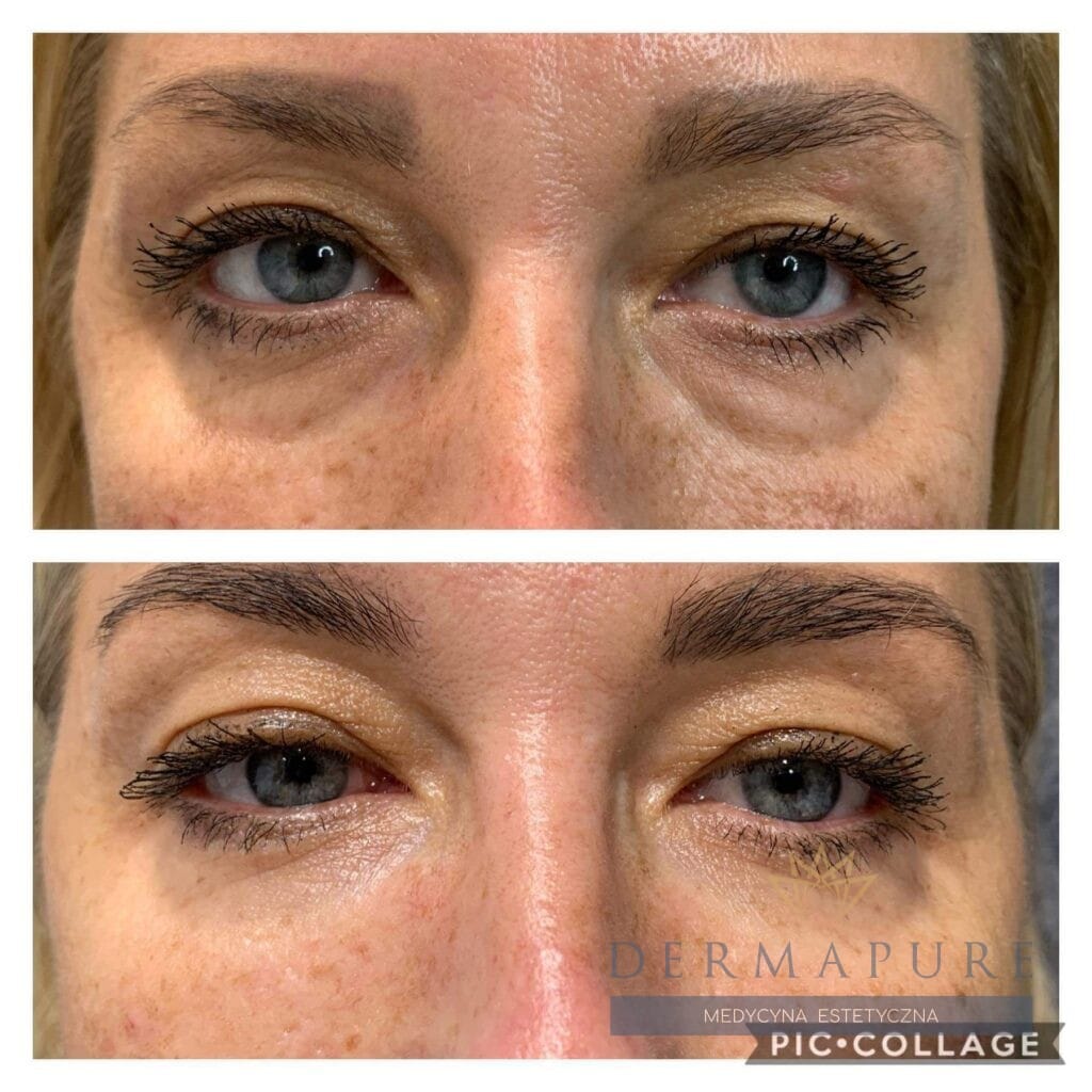 Efekt liftingu doliny łez w klinice Dermapure Warszawa.