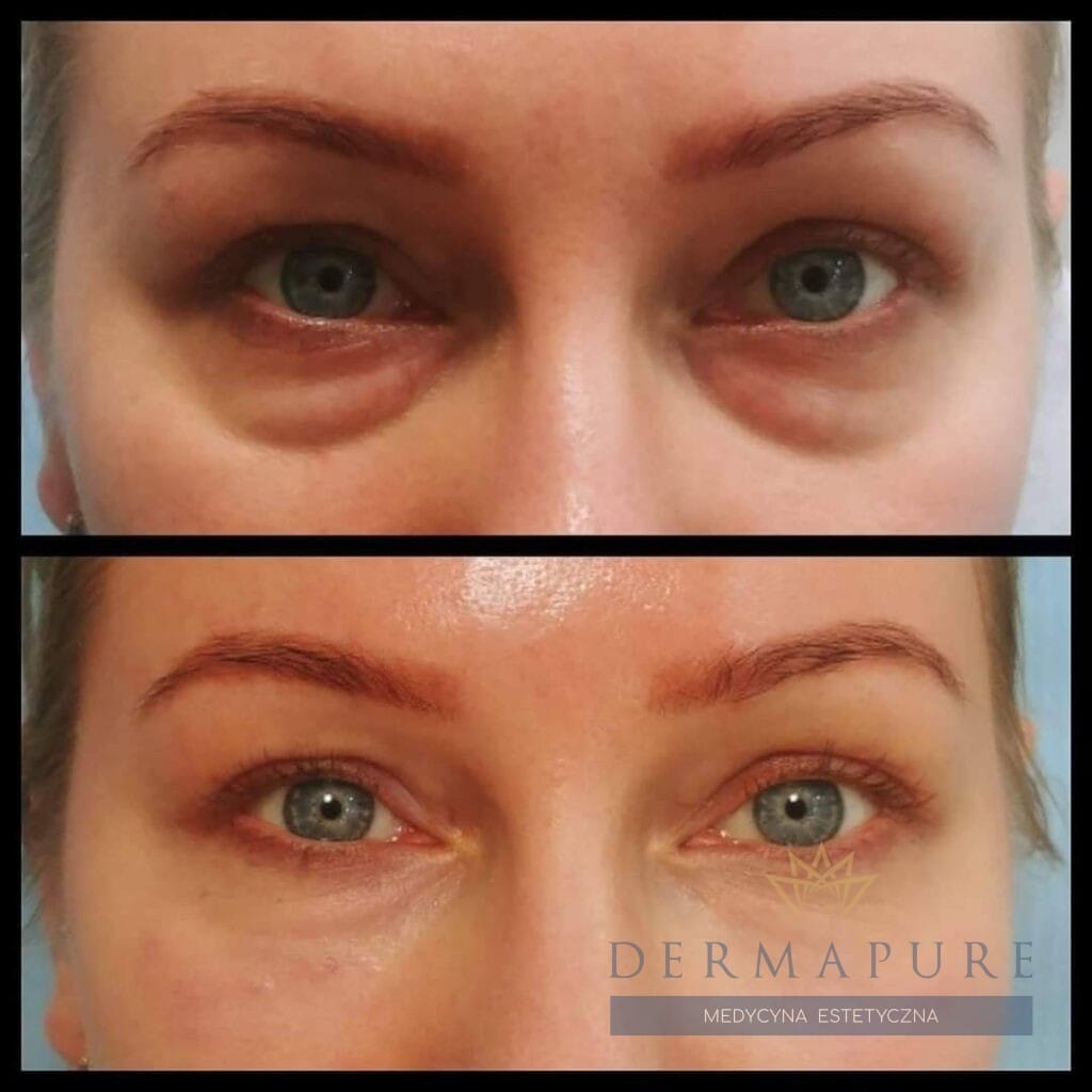Dermapure Warszawa - dolina łez przed i po zabiegu.