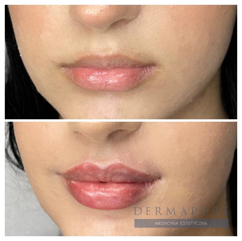 Klinika Dermapure w Warszawie – profesjonalne modelowanie ust.