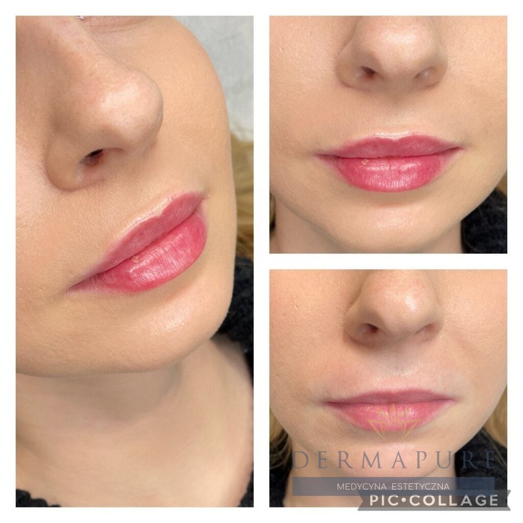 Dermapure Warszawa – bezpieczne powiększanie ust.