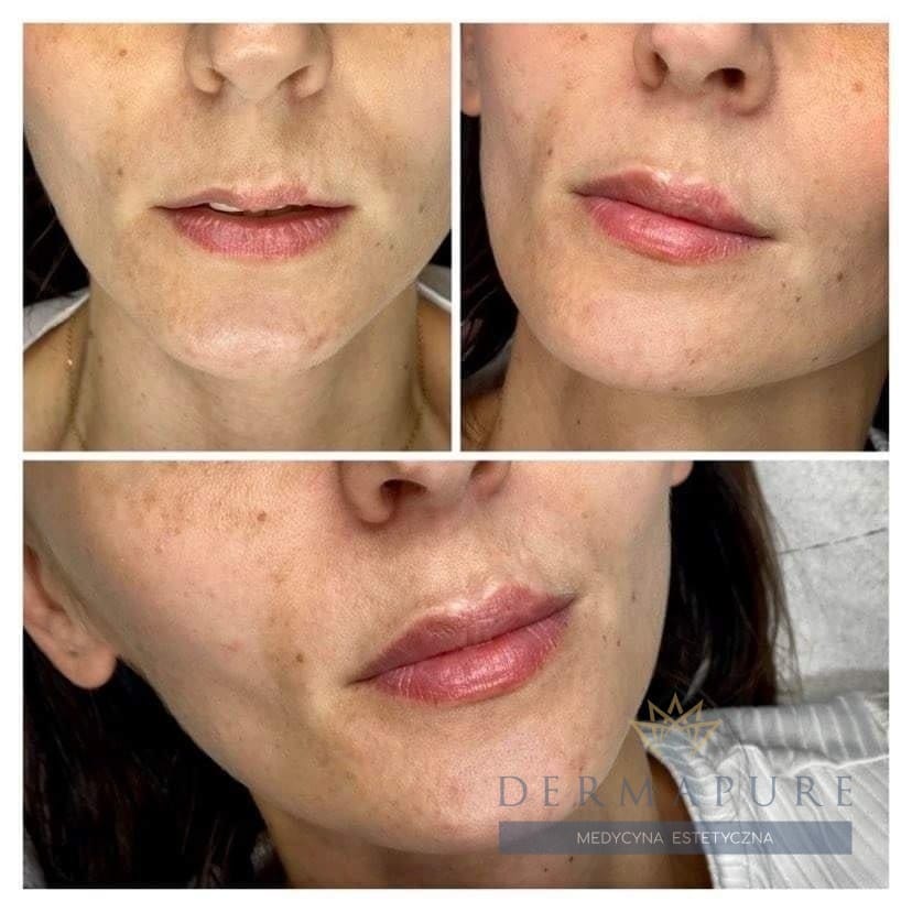 Powiększanie ust w Dermapure, Warszawa – zdjęcia przed i po.