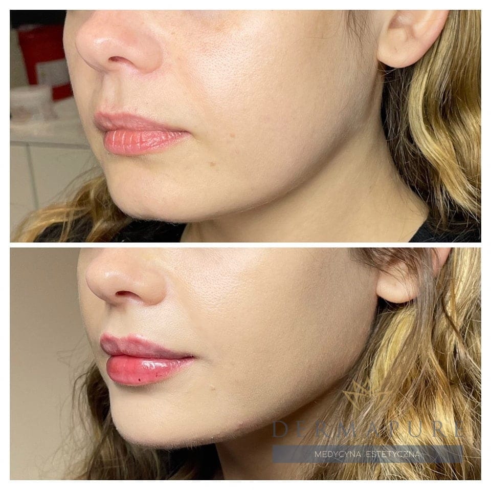 Zabieg liftingu twarzy w Dermapure, Warszawa