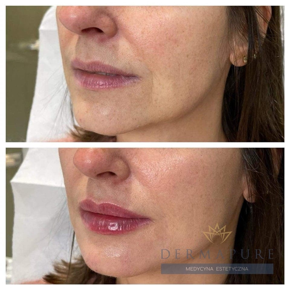Klinika Dermapure w Warszawie – zabieg powiększania ust.