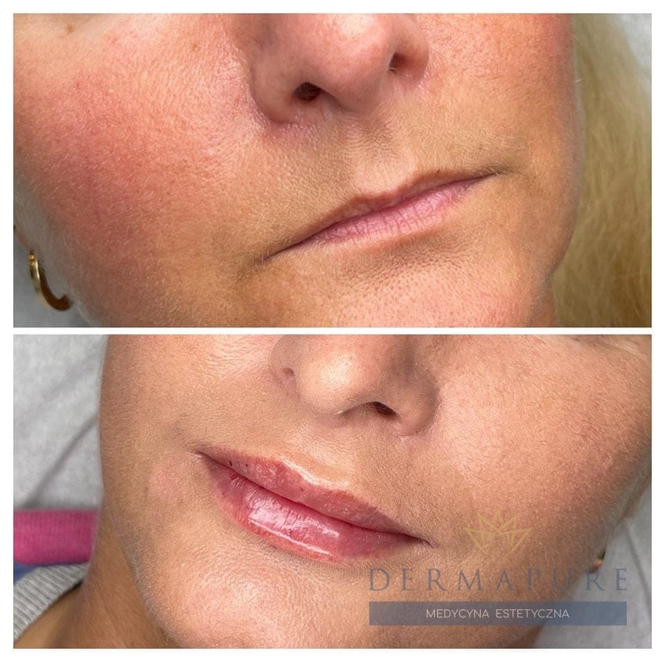 Dermapure Warszawa – powiększanie ust naturalnym kwasem hialuronowym.