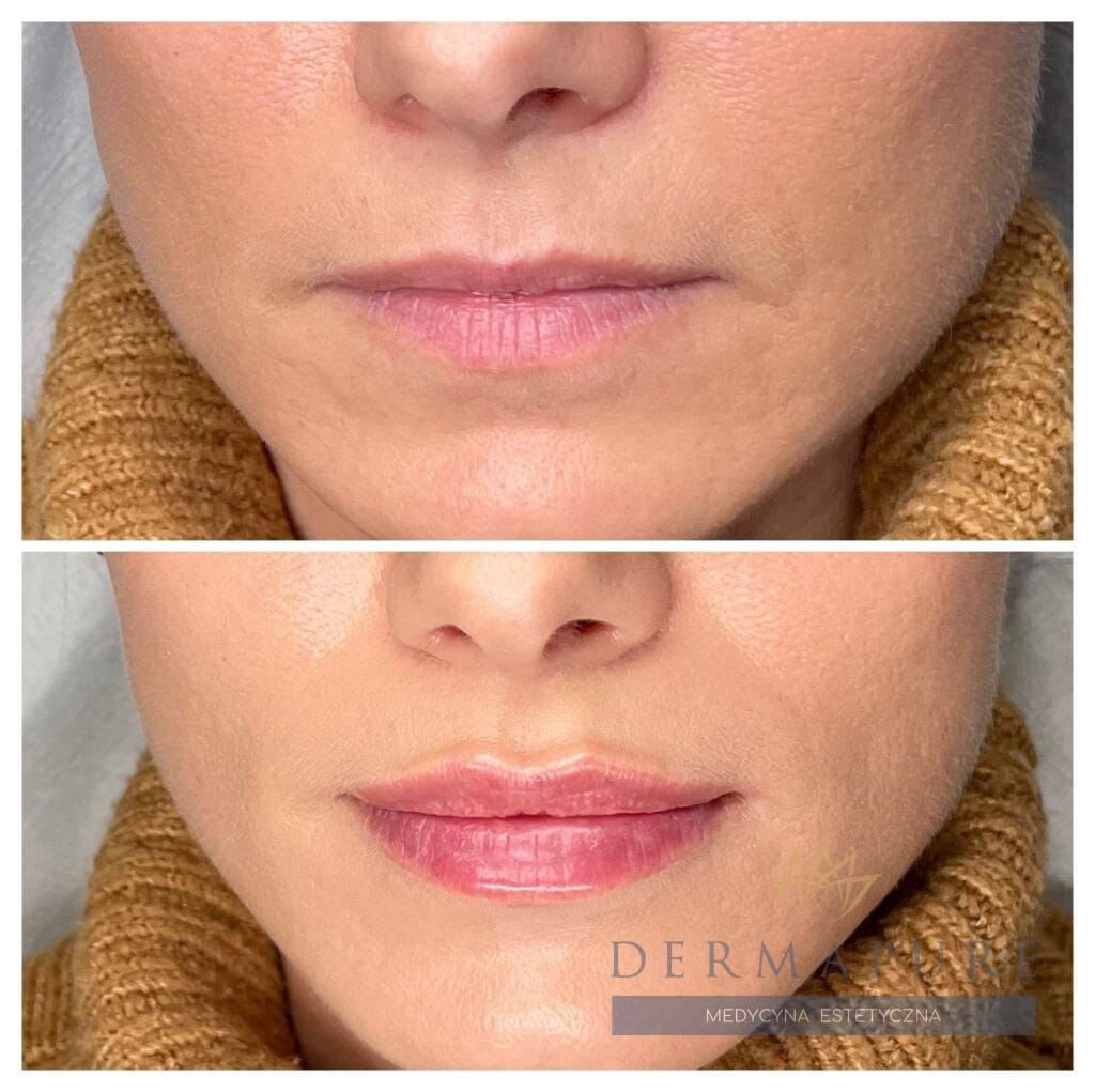 Powiększone usta po zabiegu w Dermapure, Warszawa.