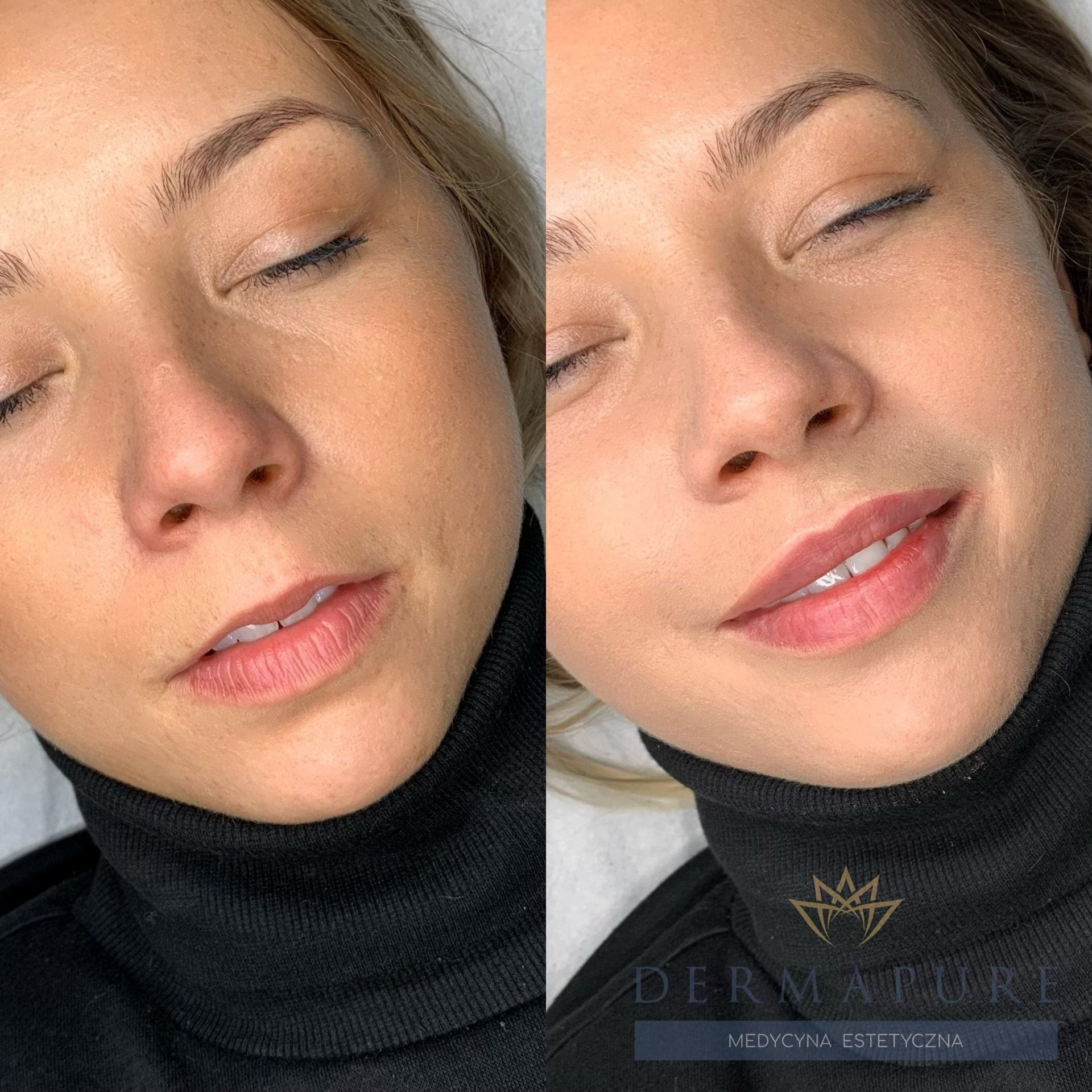 Zabieg powiększania ust w Dermapure Warszawa – pełniejsze usta.
