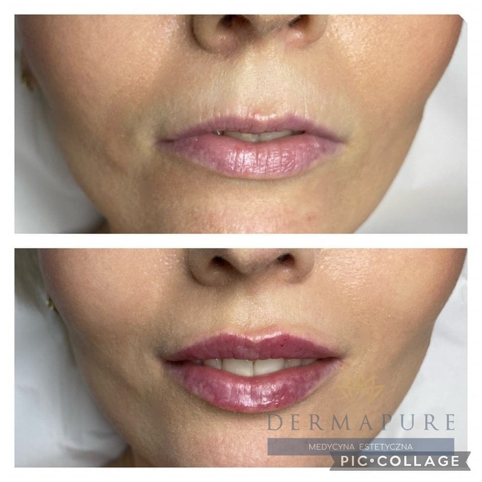 Zabieg powiększania ust w klinice Dermapure, Warszawa.