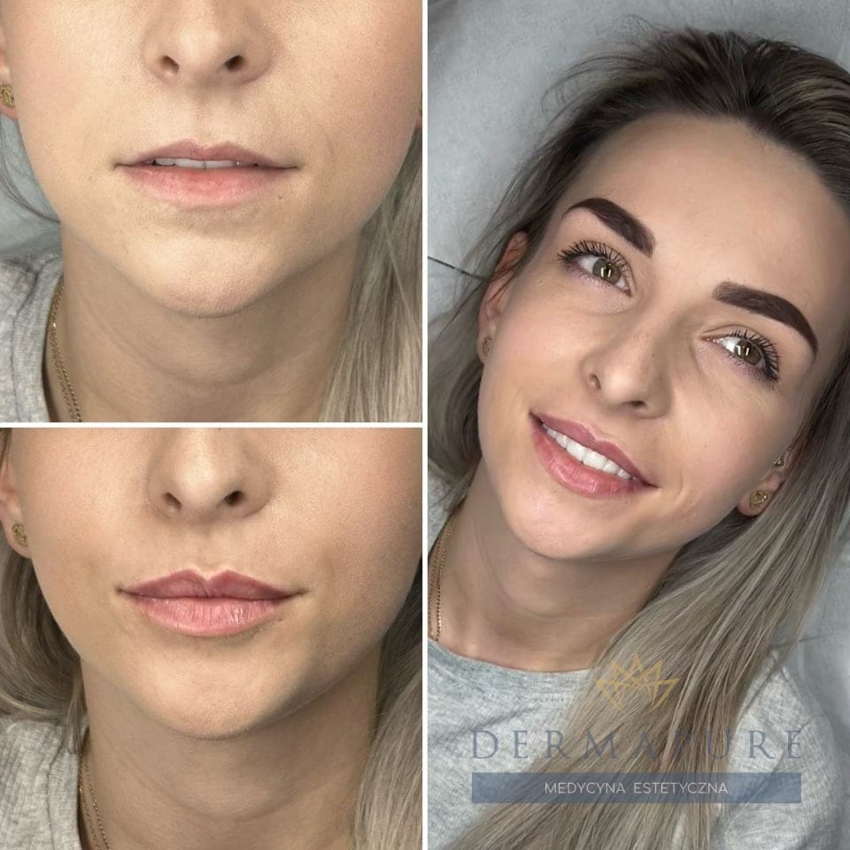 Rezultaty powiększania ust w Dermapure, Warszawa.