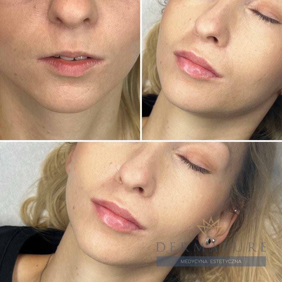Modelowanie i powiększanie ust w Dermapure, Warszawa.