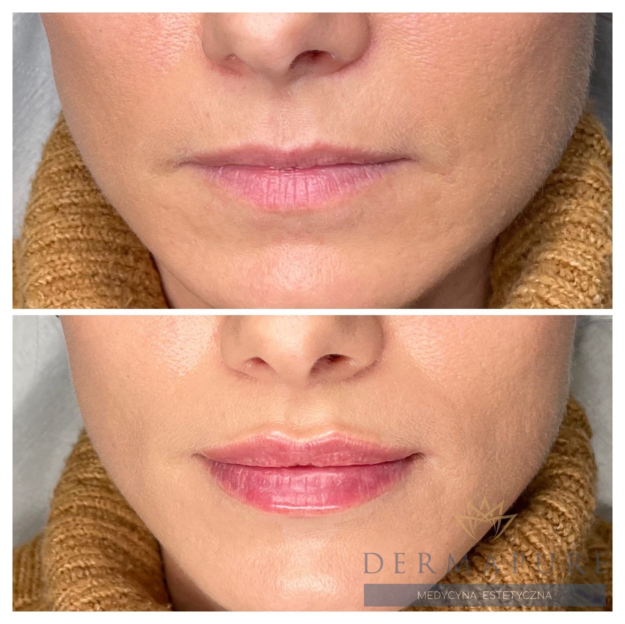 Modelowanie ust kwasem hialuronowym, salon kosmetyczny w Warszawie