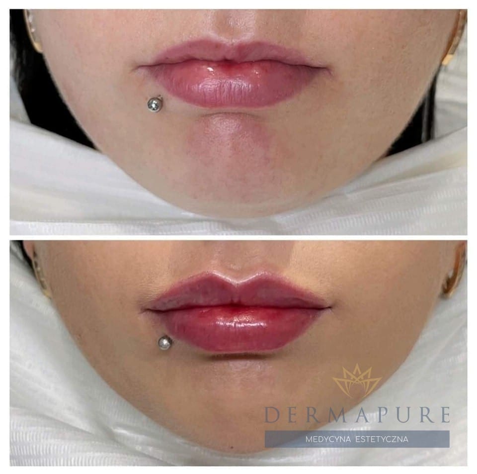Zabieg na usta - powiększanie i modelowanie kwasem hialuronowym w Warszawie