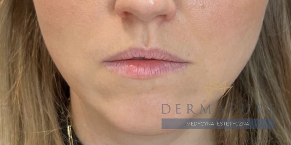 Warszawa: Naturalne powiększenie ust kwasem hialuronowym