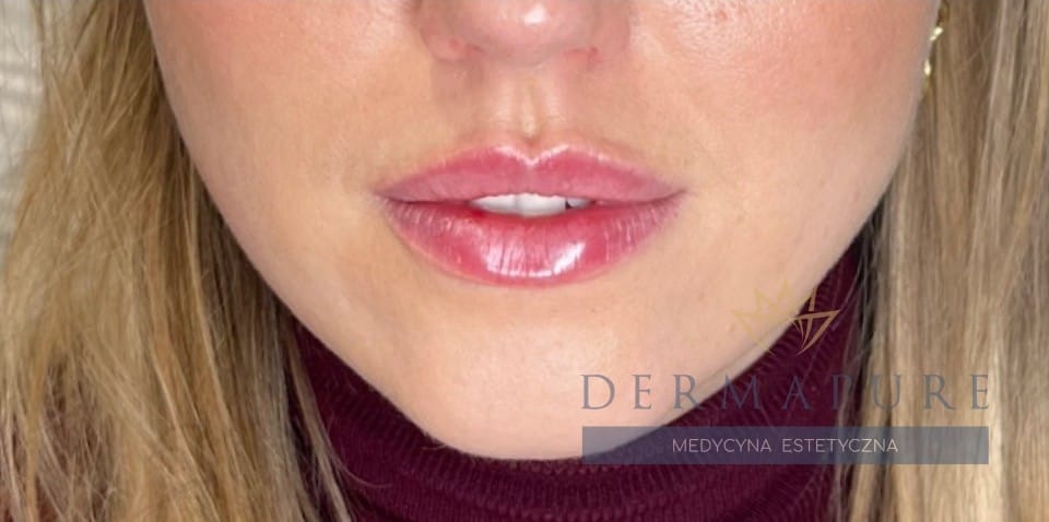 Korekta i powiększenie ust kwasem hialuronowym w Warszawie