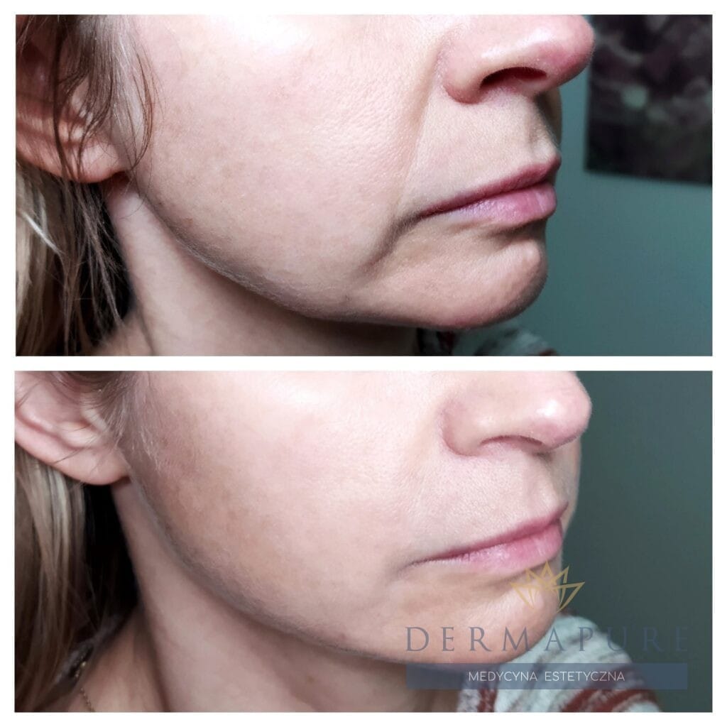 Wolumetria bruzdy nosowo wargowej i marionetki