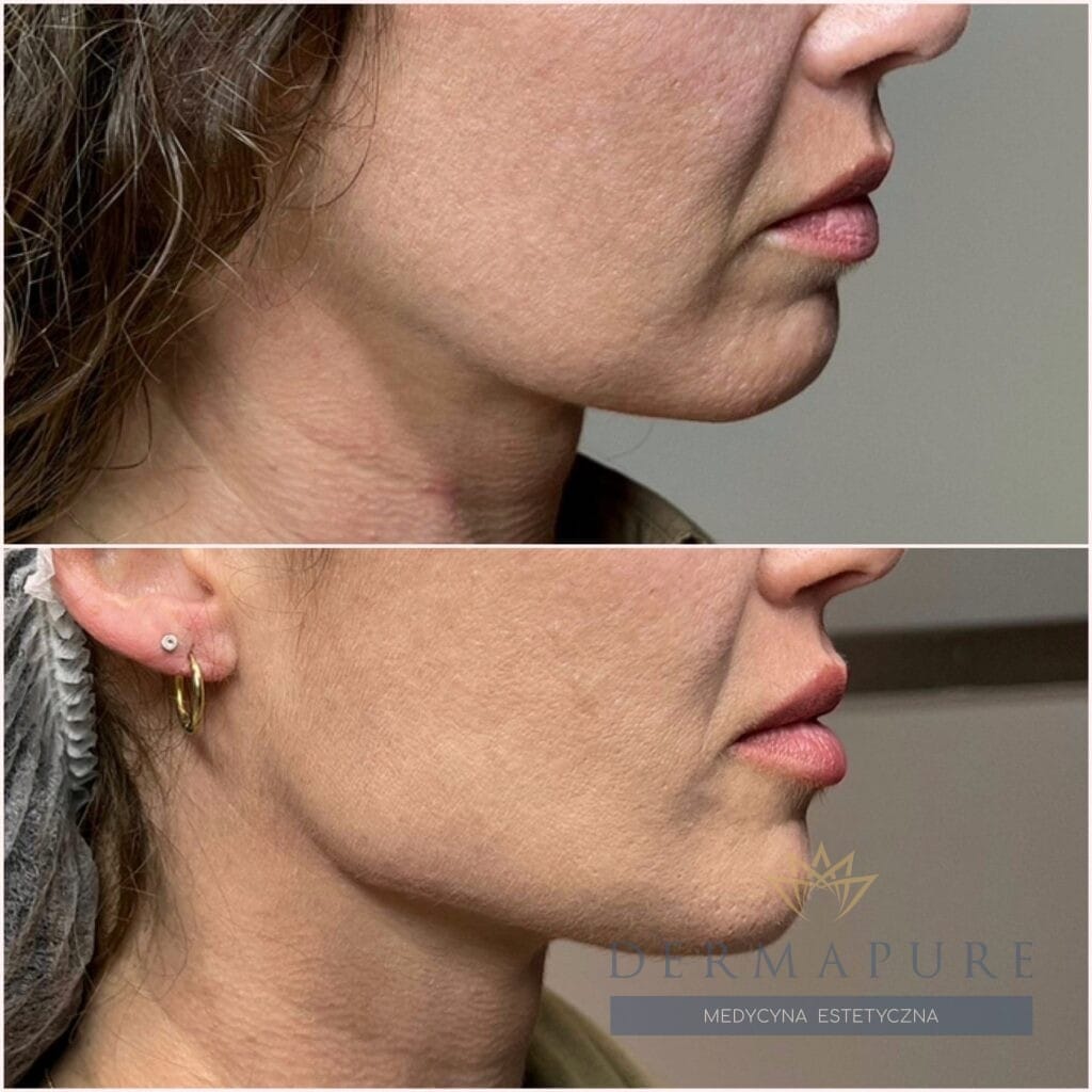 Efekty zabiegów medycyny estetycznej w Warszawie